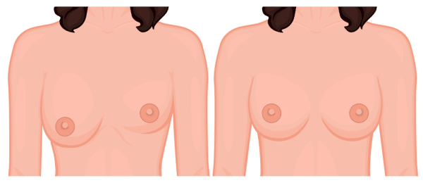 Asymmetry of the breast