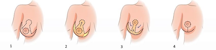 Mammoplasty 3
