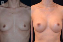 Увеличение груди 1 месяц после оп.jpg